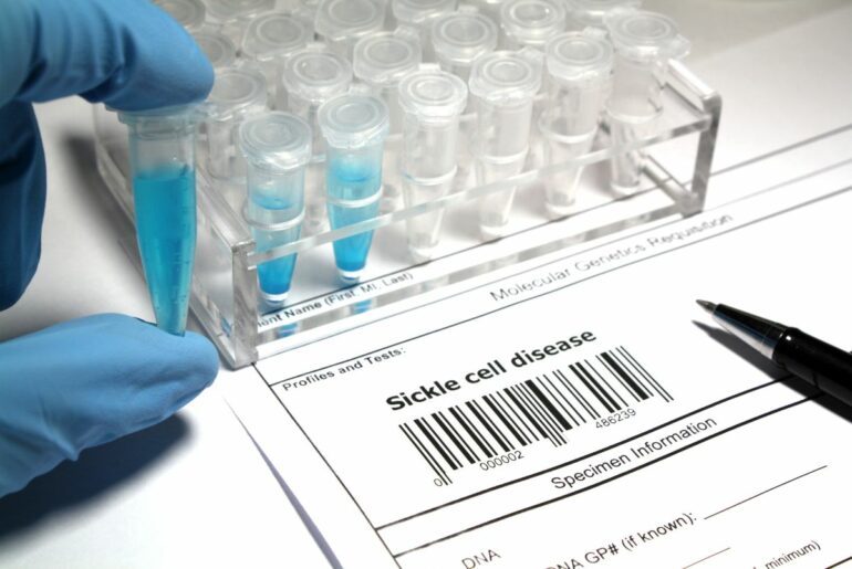 Blue-gloved fingers hold a vial next to a rack of laboratory test tubes, on top of a paper that reads "Sickle cell disease"